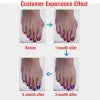Bunion Corrector Silicone Toe Sleeves and Separator My Store